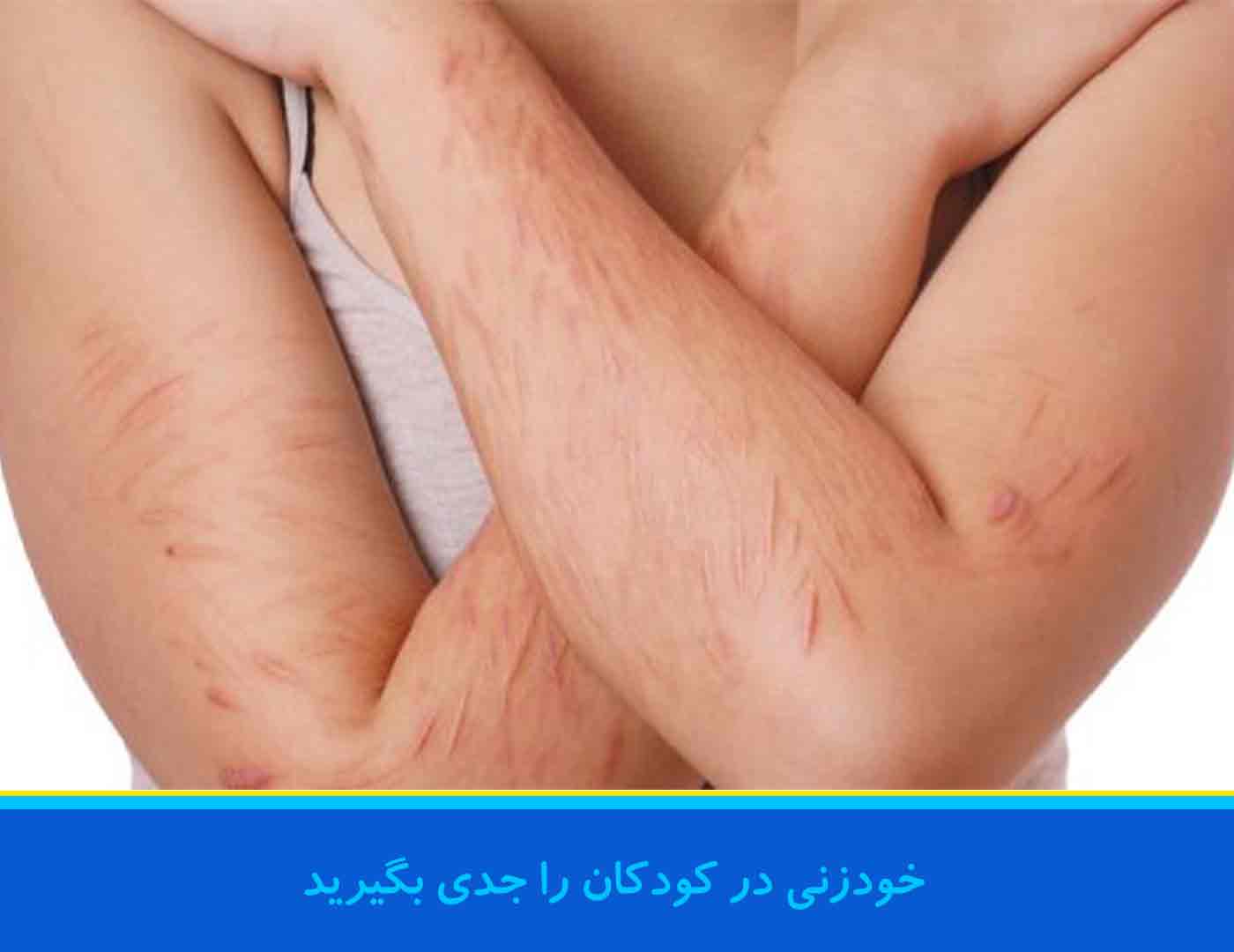 خودزنی در کودکان